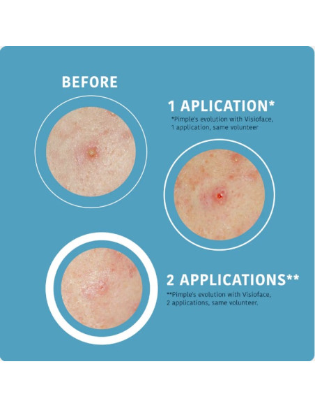 IROHA NATURE ACNE PRONE SOS -aknelaastarit salisyylihapolla, teepuulla ja Centella Asiaticalla 18 kpl.